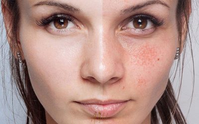 پوشاندن لکه های صورت با آرایش